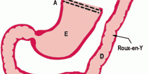 Z Line Irregular Results After Endoscopy Intestinal Problems Bowel   Gastric Bypass F 500x250 