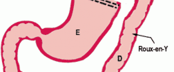 z-line-irregular-results-after-endoscopy-intestinal-problems-bowel