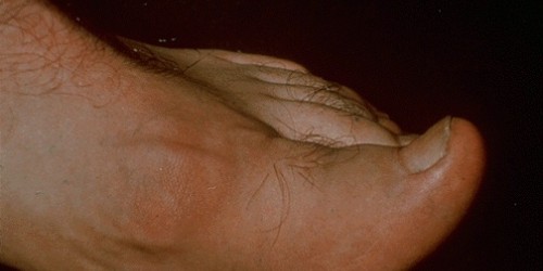 Gout and Pseudogout: Diagnosis & Treatment