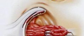 Hemorrhoidectomy: Preparation and Recovery