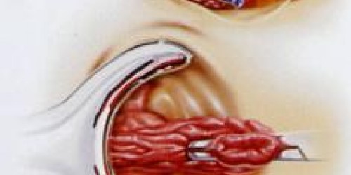 Hemorrhoidectomy: Preparation and Recovery