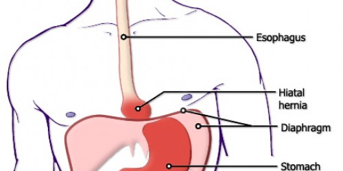 Hiatal hernia