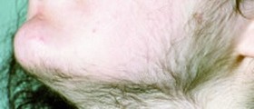 Hirsutism increased hair growth in women