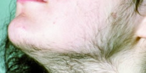 Hirsutism increased hair growth in women