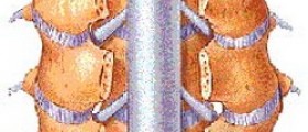 Laminectomy