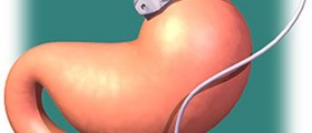 Weight Loss Surgeries