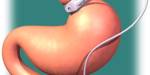 Weight Loss Surgeries