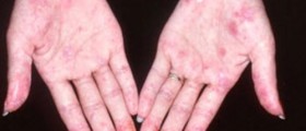 Systemic lupus erythematosus (SLE)