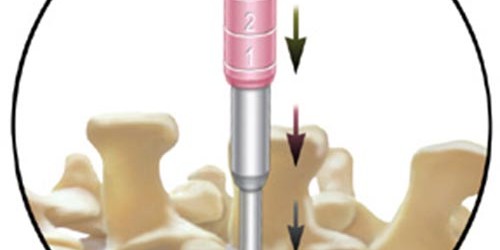 Discectomy: Pros & Cons