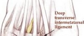 Morton's Neuroma
