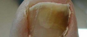 Nail Fungus Treatment