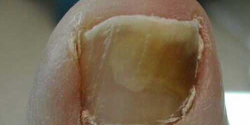 Nail Fungus Treatment