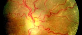 Intracranial Hypertension: Pseudotumor Cerebri