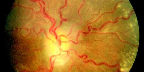 Intracranial Hypertension: Pseudotumor Cerebri