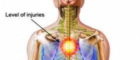 Temporary Paralysis