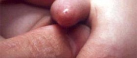 Phimosis Related Complications