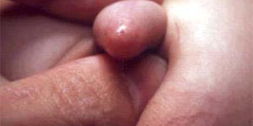 Phimosis Related Complications