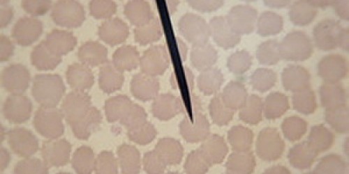 Myeloproliferative Disorders: Polycythemia vera