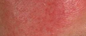 Rosacea: Symptoms & treatment