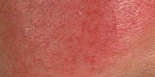 Rosacea: Symptoms & treatment