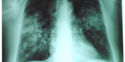 Sarcoidosis Treatment