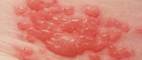 Shingles & Stress