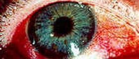 Sjogren's syndrome fact sheet