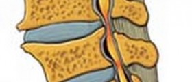 Spinal Cord Stenosis