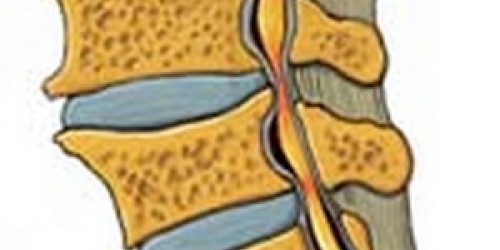 Spinal Cord Stenosis