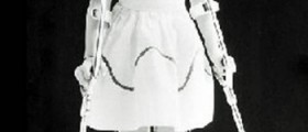Polio (PPS): Symptoms & Treatment