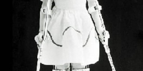 Polio (PPS): Symptoms & Treatment