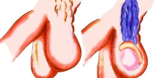 Varicocele embolization