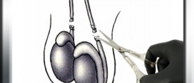 Complications following Vasectomy