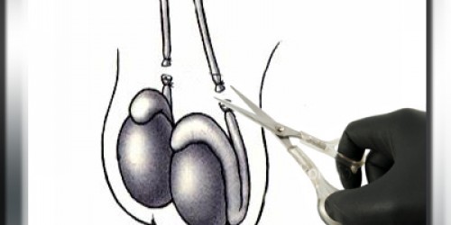 Complications following Vasectomy