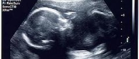 3D ultrasound during pregnancy