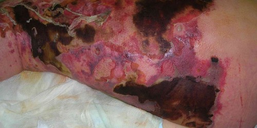 Necrotizing Fasciitis: Flesh Eating Disease