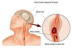 A transient ischemic attack (TIA)- Mini stroke without permanent damage