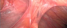Abdominal Adhesions Can Cause Bowel Obstruction