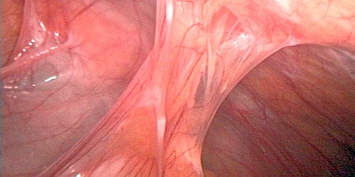 Abdominal Adhesions Can Cause Bowel Obstruction