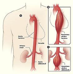 Abdominal aortic aneurysm diagnostic methods