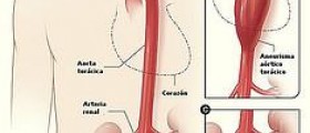 Abdominal aortic aneurysm diagnostic methods