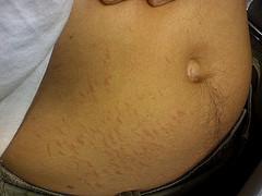 Abdominal bloating treatment