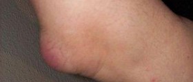 About acute bursitis