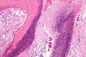 About benign pilomatrixoma