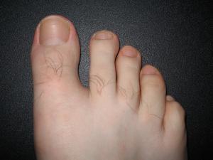 About bruised toenails