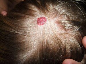 About cavernous hemangioma