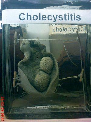 About Cholecystitis diet