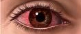 About chronic keratoconjunctivitis