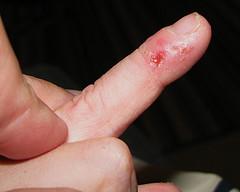 About dermatitis dyshidrotic