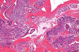 About endometrial conditions